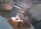 Эндоскопическая септопластика  http://estheticcenter.ru