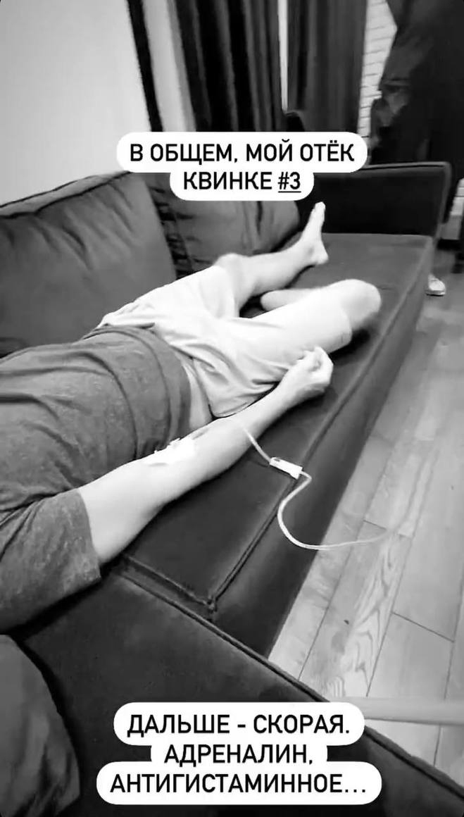 Влад Яма об аллергической реакции после ужина в ресторане