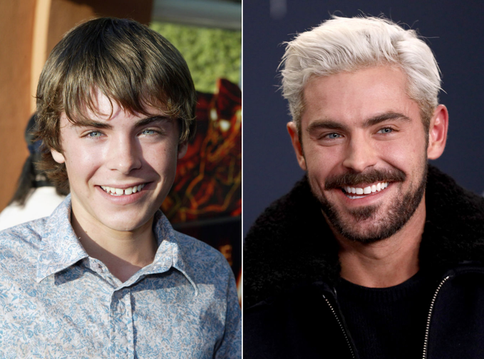 Во все 32: фото звезд до и после реставрации зубов