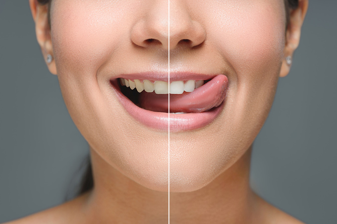 Какие продукты отбеливают зубы?