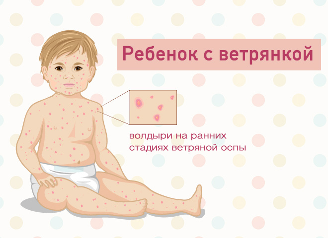 ветрянка у взрослых, ветрянка у детей