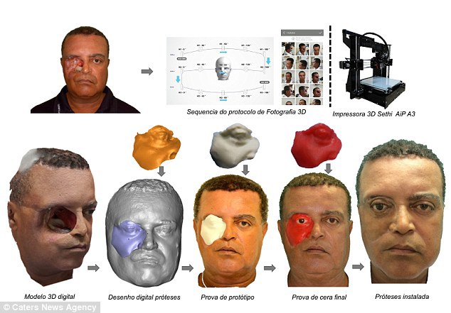 Протез лица с помощью 3D-печати: бразильцу сделали протез лица с помощью смартфона и 3D-принтера