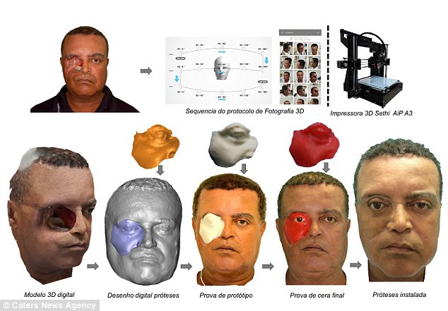 Протез обличчя за допомогою 3D-друку: бразильцеві зробили протез обличчя за допомогою смартфона і 3D-принтера