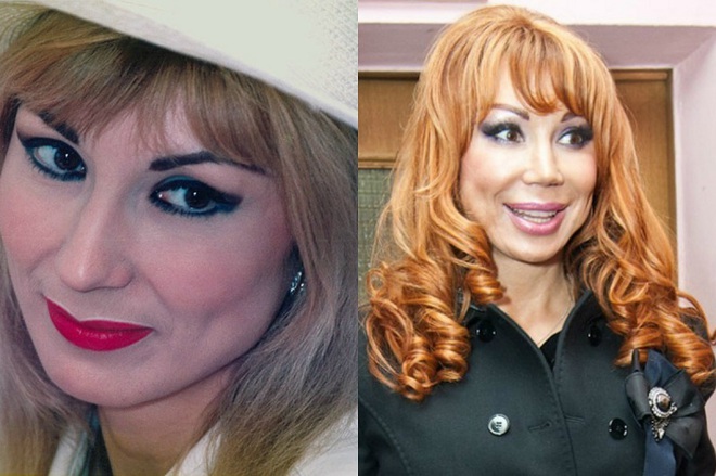 Знаменитости до и после пластики