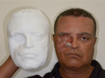 Протез лица с помощью 3D-печати: бразильцу сделали протез лица с помощью смартфона и 3D-принтера