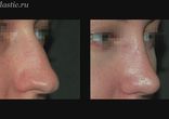 Ринопластика лучшие хирурги Москвы  http://estheticcenter.ru