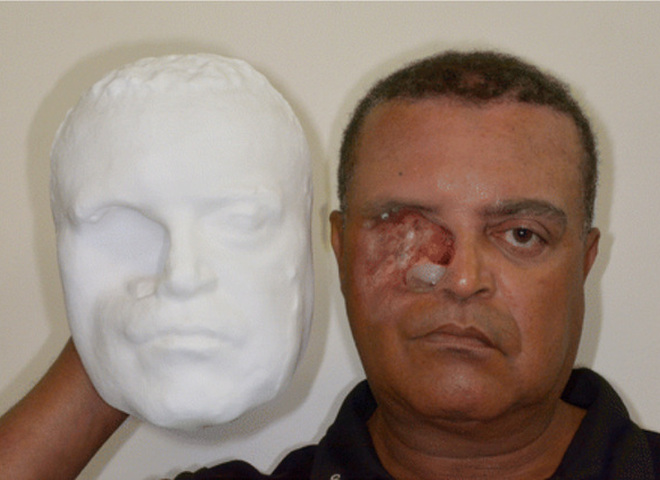 Протез обличчя за допомогою 3D-друку: бразильцеві зробили протез обличчя за допомогою смартфона і 3D-принтера